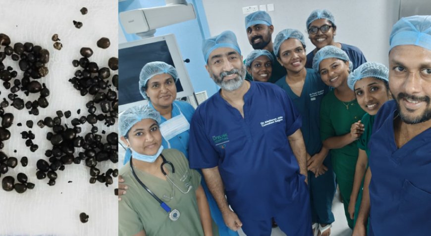 വീട്ടമ്മയുടെ പിത്താശയത്തിൽ നിന്ന് നീക്കിയത് 222 കല്ലുകൾ.