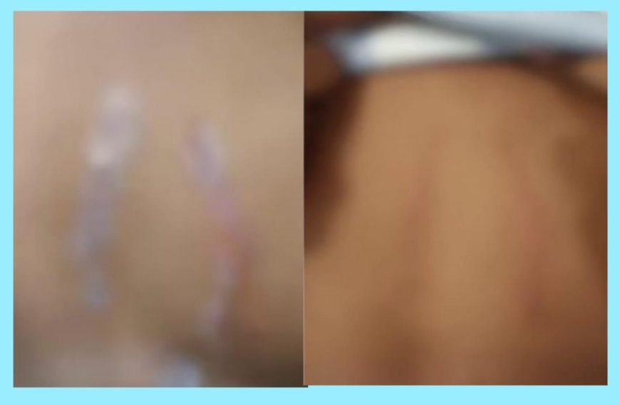 അമ്മയുടെ കൂടെ കിടന്നതിന് 12 വയസ്സുകാരനെ ക്രൂരമായി മർദ്ദിച്ച അമ്മയുടെ സുഹൃത്തും, അമ്മയും അറസ്റ്റിൽ.