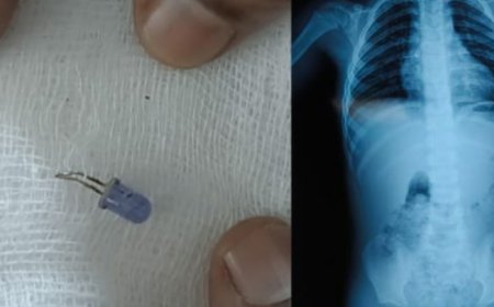 മൂന്നു വയസ്സുകാരന്റെ ശ്വാസനാളത്തിൽ കുടുങ്ങിയ ബൾബ് പുറത്തെടുത്തു