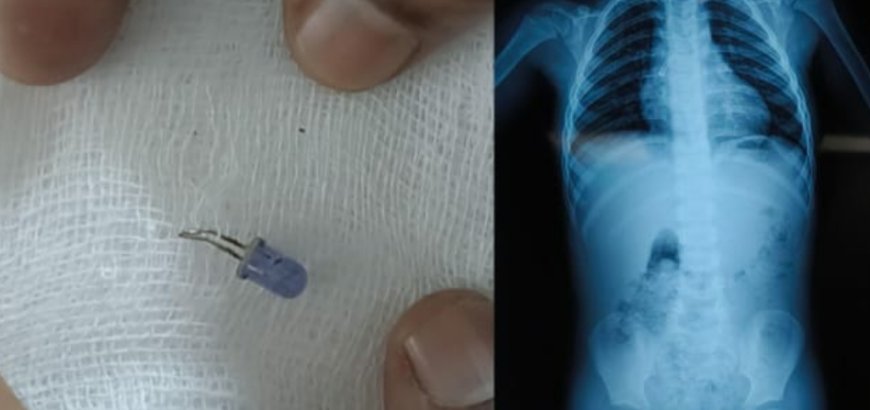 മൂന്നു വയസ്സുകാരന്റെ ശ്വാസനാളത്തിൽ കുടുങ്ങിയ ബൾബ് പുറത്തെടുത്തു