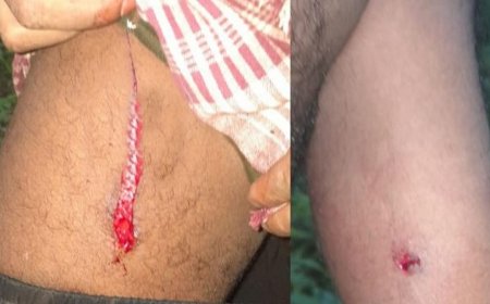 കാട്ടുപന്നിയുടെ കുത്തേറ്റ് ടാപ്പിംഗ് തൊഴിലാളിക്ക് പരിക്ക്